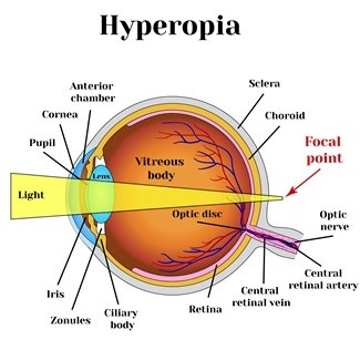 Ilustración que describe la hipermetropía