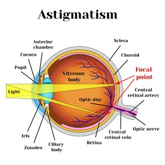 Ilustración que describe varias partes del ojo con astigmatismo